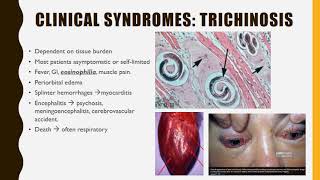 Trichinella SPIRALIS [upl. by Ohcamac]