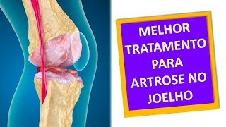 ARTROSE NO JOELHO TRATAMENTO DE FISIOTERAPIA Clínica Dr Robson Sitta [upl. by Prosperus639]