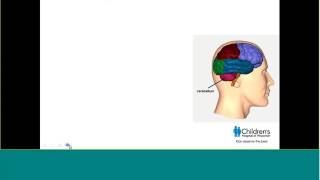 PHACE Syndrome Longterm outcomes [upl. by Ecinhoj854]