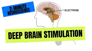 Parkinsons Disease  Clinical Presentation  Part 1 [upl. by Rimidalb109]