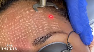 Minimize Acne Scarring With Laser Resurfacing [upl. by Brader212]