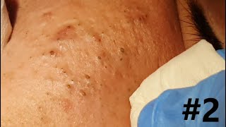 BIG BLACKHEADS EXTRACTIONS on Happy  2 [upl. by Suehtomit]