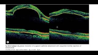 Kanski Clinical Ophthalmology Made Easy  Macula 5 B [upl. by Edrei210]