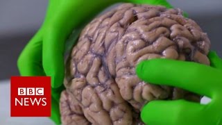 This Brain Implant Could Change Lives [upl. by Farant]