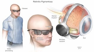 Orbital Eye Facial Prosthesis [upl. by Raseta]