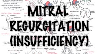 Mitral Reguritation insufficiency  Overview signs and symptoms pathophysiology treatment [upl. by Reeve]