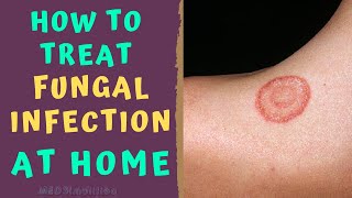 HOW TO TREAT SKIN FUNGAL INFECTION INFECTION AT HOME TINEA RINGWORM REMEDIES HOW TO CURE [upl. by Nitsrik]