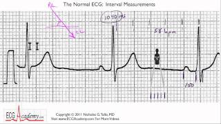 Interval Measurements 64  ECG  EKG Interpretation  BASIC [upl. by Enaerb]