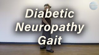 Diabetic Neuropathy Gait [upl. by Tnecnev]