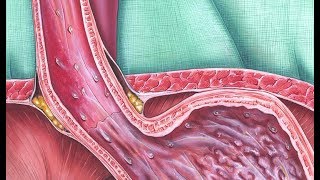 Barrett’s Esophagus Screening [upl. by Epotimet]