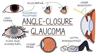 Understanding Acute Angle Closure Glaucoma [upl. by Goodkin]