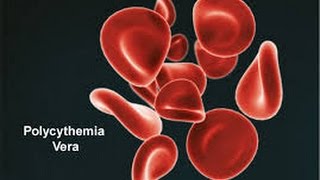 Polycythemia Vera [upl. by Schumer952]