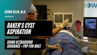 Bakers Cyst Aspiration  PRP [upl. by Illac542]