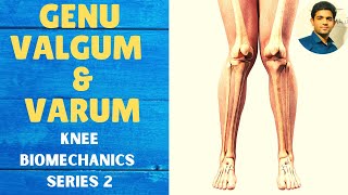 GENU VALGUM amp GENU VARUM  Knee Complex Biomechanics [upl. by Kcyred]