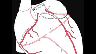 Assessing Lesion Severity in Coronary Angiography [upl. by Wilde]