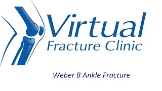 Weber B Fracture [upl. by Diao]