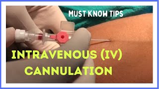 INTRAVENOUS IV CANNULATION in 5 mins How to insert [upl. by Rozelle]