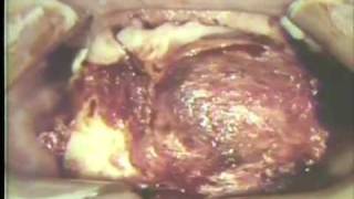 Removal of Large Ameloblastoma of Mandible [upl. by Qerat]