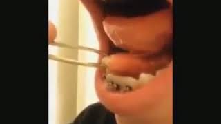 Sialolithiasis—Salivary duct stone removal [upl. by Alyel]