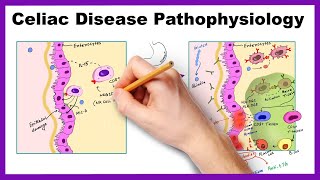 Understanding Coeliac Disease [upl. by Burton]