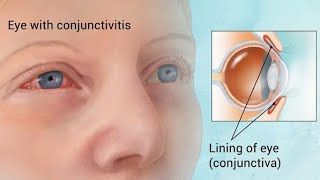 Conjunctivitis  Ophthalmology Videos [upl. by Vena]