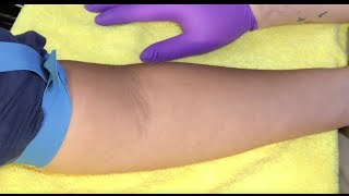 Tips For Locating Difficult Veins [upl. by Ydasahc]