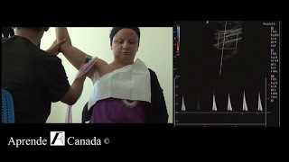 Upper Extremity Arterial Doppler Trailer [upl. by Darcia]