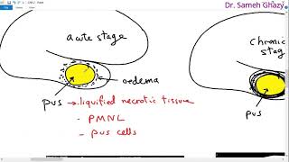 Systemic pathology 18  CNS 2 brain abscess and degenerations  DRSAMEH GHAZY [upl. by Ayotna]