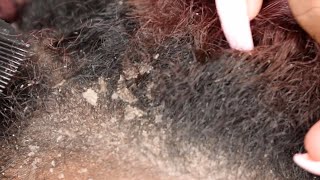 ITCHY DRY SCALP  SCRATCHING DANDRUFF  RAKING SCALP [upl. by Lashonde]