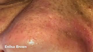 Blackheads Extractions and Acne Treatment on Daryl [upl. by Nahum]