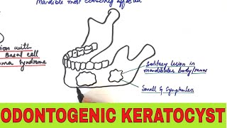 Odontogenic Keratocyst  Clinical Radiographic and Histopathologic Features [upl. by Eidnas317]